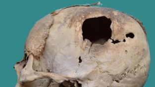 Un cranio trapanato del 1700